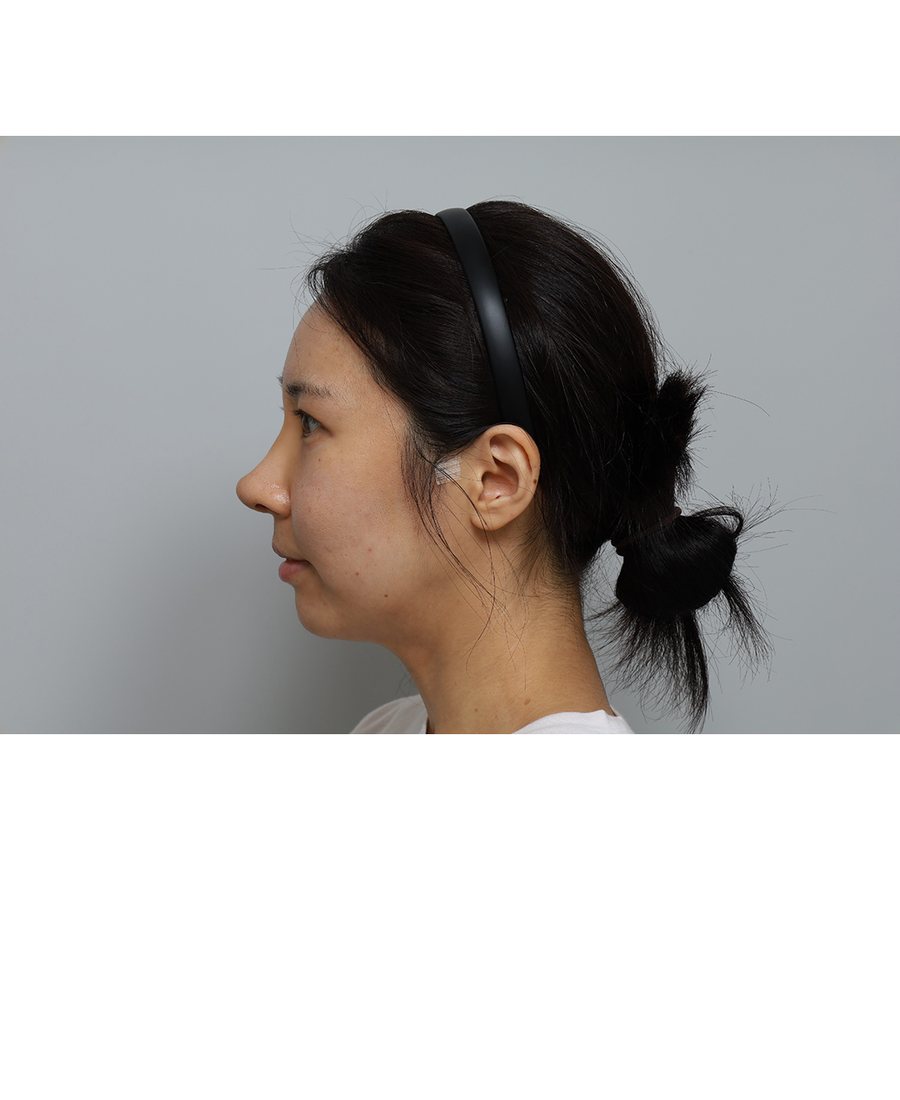 Bridge Rhinoplasty