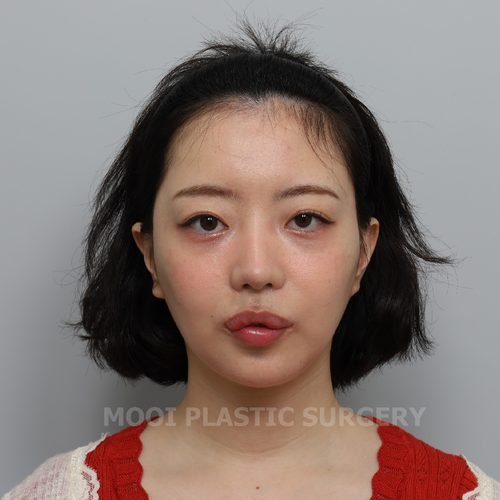 Hump Nose Correction