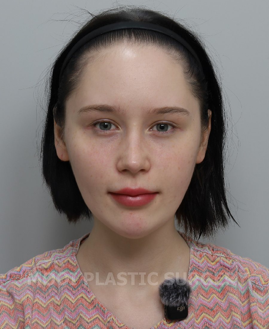 Alarplasty