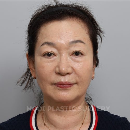 Incisional Double Eyelid Surgery