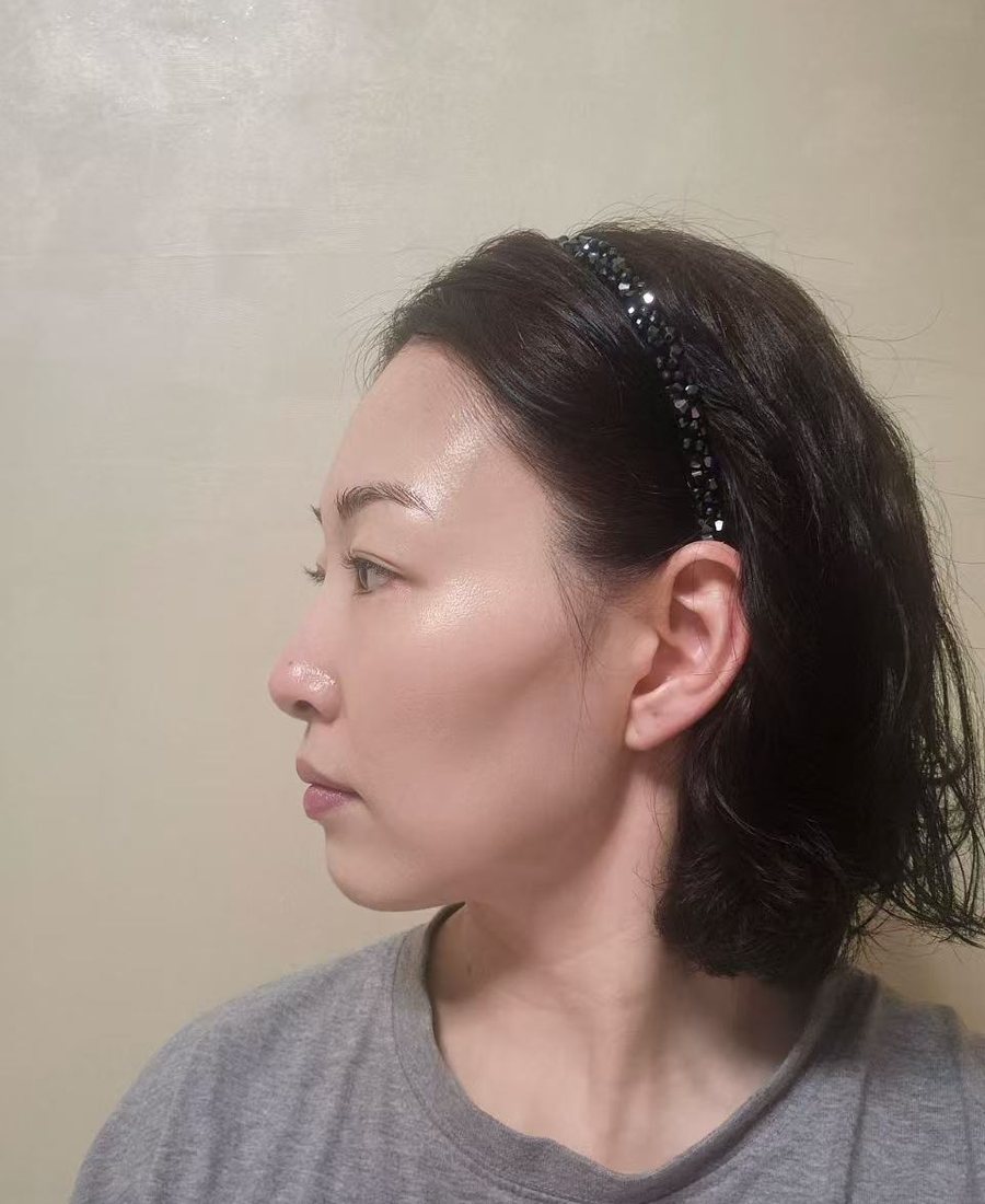 Rhinoplasty (Full)
