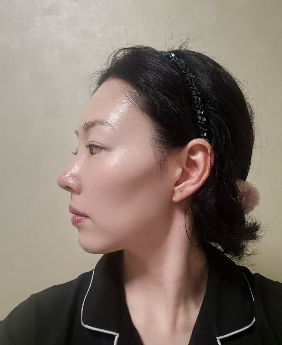 Revision Rhinoplasty