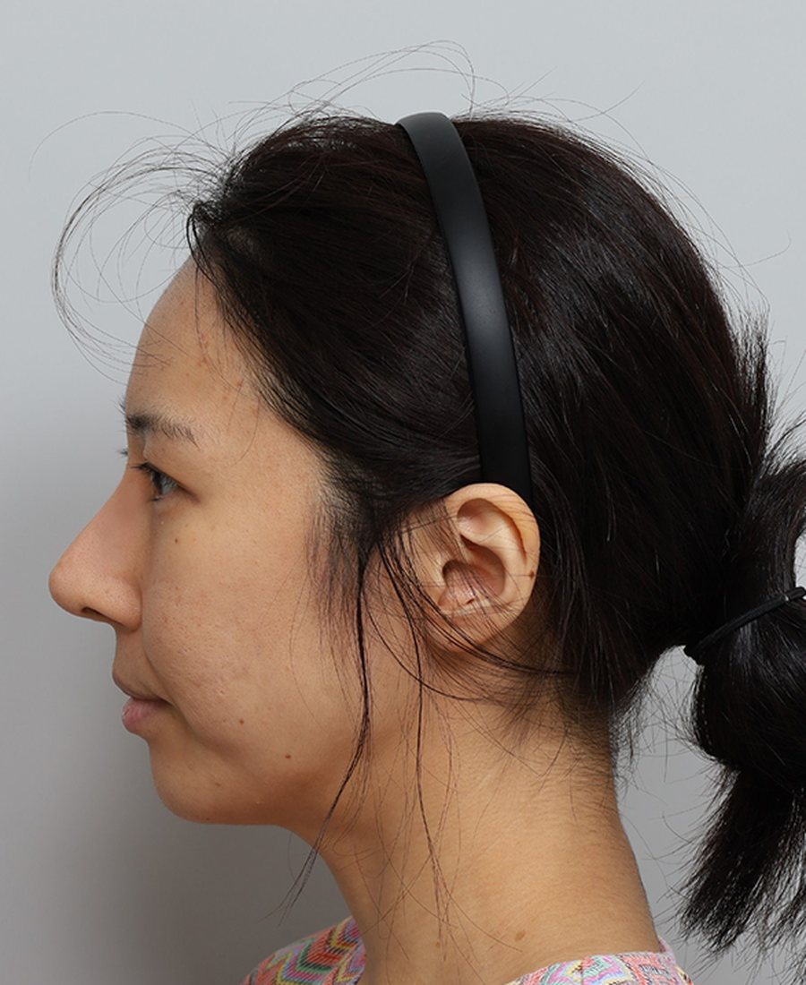 Korean-Style Rhinoplasty