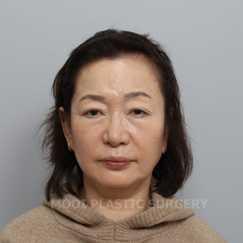 Non-Incisional Double Eyelid Surgery