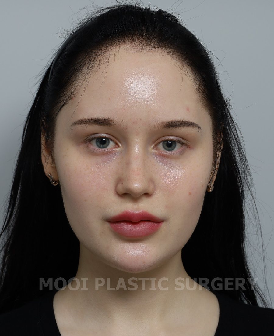 Tip Plasty